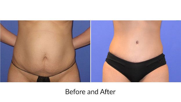 Before and After: Tummy Tuck a